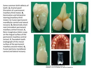 Some common birth defects of
teeth. A, Enamel pearl
(furcation of a permanent
maxillary third molar). B,
Gemination and tetracyline
staining (maxillary third
molar). C, Fusion (permanent
mandibular central and lateral
incisors). D, Abnormally short
root (microdont permanent
maxillary central incisor). E,
Dens invaginatus (talon cusps
on the lingual surface of the
permanent maxillary central
incisor). F, Taurodont tooth
(radiograph of the mesial
surface of the permanent
maxillary second molar). G,
Fusion (primary mandibular
central and lateral incisors).
82
 
