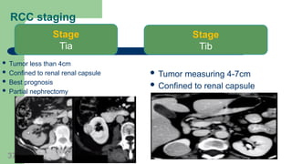 4cm Rcc 12.Renal tumors Lecture..............pptx
