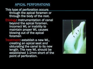 This type of perforation occurs
through the apical foramen or
through the body of the root.
Etiology: Instrumentation of canal
beyond the apical foramen.
Incorrect WL or inability to
maintain proper WL causes
blowing out of the apical
foramen
Treatment: establish a new WL,
creating an apical seat and
obturating the canal to its new
length. The new WL should be
established 1-2mm short of the
point of perforation.
 
