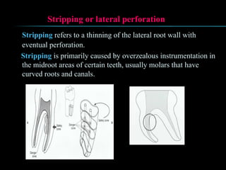 Stripping or lateral perforation
Stripping refers to a thinning of the lateral root wall with
eventual perforation.
Stripping is primarily caused by overzealous instrumentation in
the midroot areas of certain teeth, usually molars that have
curved roots and canals.
 