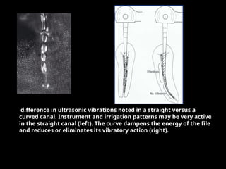 difference in ultrasonic vibrations noted in a straight versus a
curved canal. Instrument and irrigation patterns may be very active
in the straight canal (left). The curve dampens the energy of the file
and reduces or eliminates its vibratory action (right).
 
