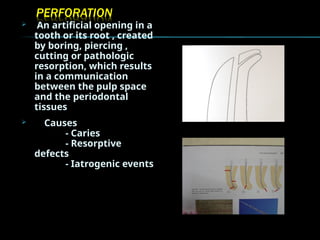  An artificial opening in a
tooth or its root , created
by boring, piercing ,
cutting or pathologic
resorption, which results
in a communication
between the pulp space
and the periodontal
tissues
 Causes
- Caries
- Resorptive
defects
- Iatrogenic events
 