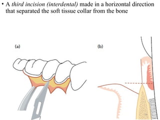 Interposition Flap PERIODONTAL FLAP - Classification, Design, Healing | PPT