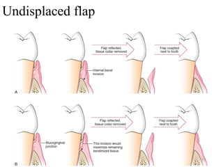 Interposition Flap PERIODONTAL FLAP - Classification, Design, Healing | PPT