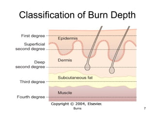 Types, classification and Management of BURNS | PPT