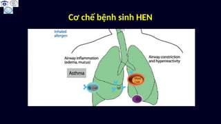 12. Hen phế quản asdh adcv bingoacd.pptx