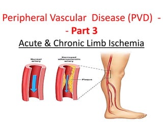 Peripheral Vascular Disease (PVD) -
- Part 3
Acute & Chronic Limb Ischemia
 