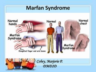 Marfan Syndrome




   Cobey, Marjorie P.
       DMD2D
 