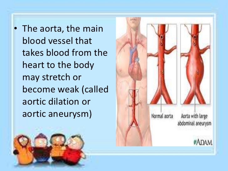 gene 6 fingers dominant cobey 12. syndrome marfan