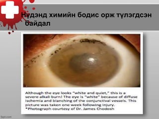 Нүдэнд химийн бодис орж түлэгдсэн
байдал
 