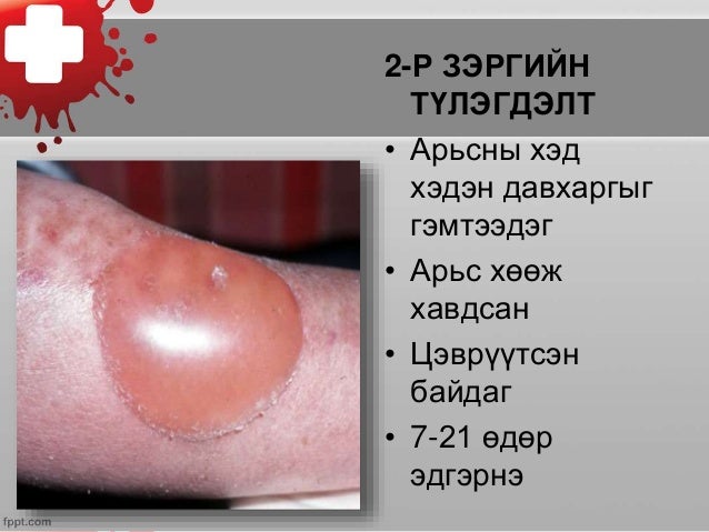 түлэгдэлт