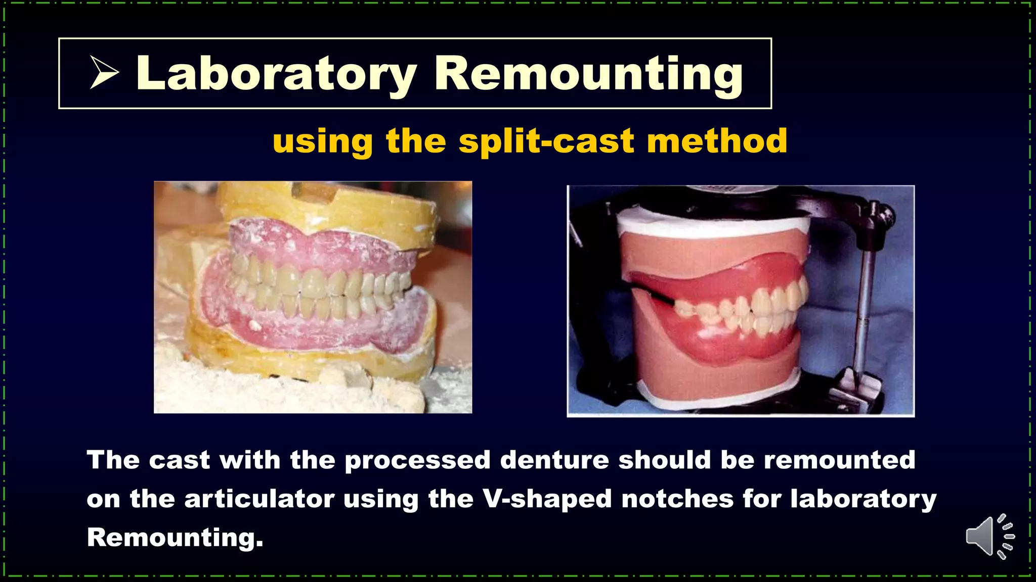  Laboratory Remounting
The cast with the processed denture should be remounted
on the articulator using the V-shaped notches for laboratory
Remounting.
using the split-cast method
 