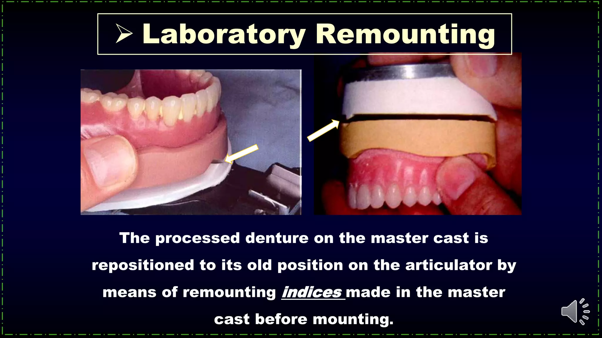 The processed denture on the master cast is
repositioned to its old position on the articulator by
means of remounting indices made in the master
cast before mounting.
 Laboratory Remounting
 
