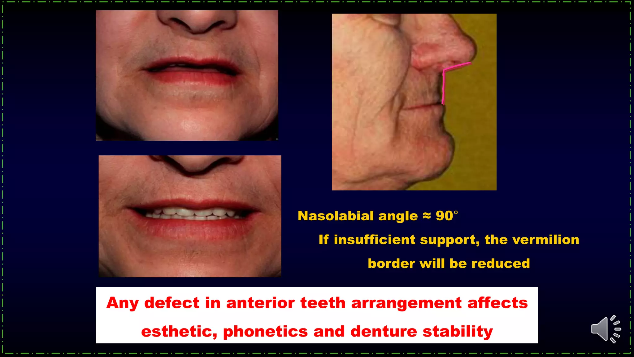 Any defect in anterior teeth arrangement affects
esthetic, phonetics and denture stability
Nasolabial angle ≈ 90°
If insufficient support, the vermilion
border will be reduced
 