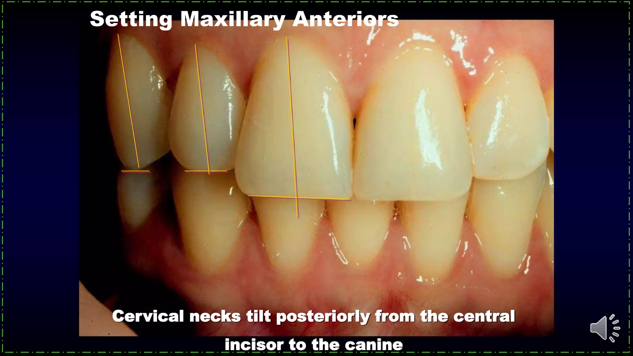 Cervical necks tilt posteriorly from the central
incisor to the canine
Setting Maxillary Anteriors
 