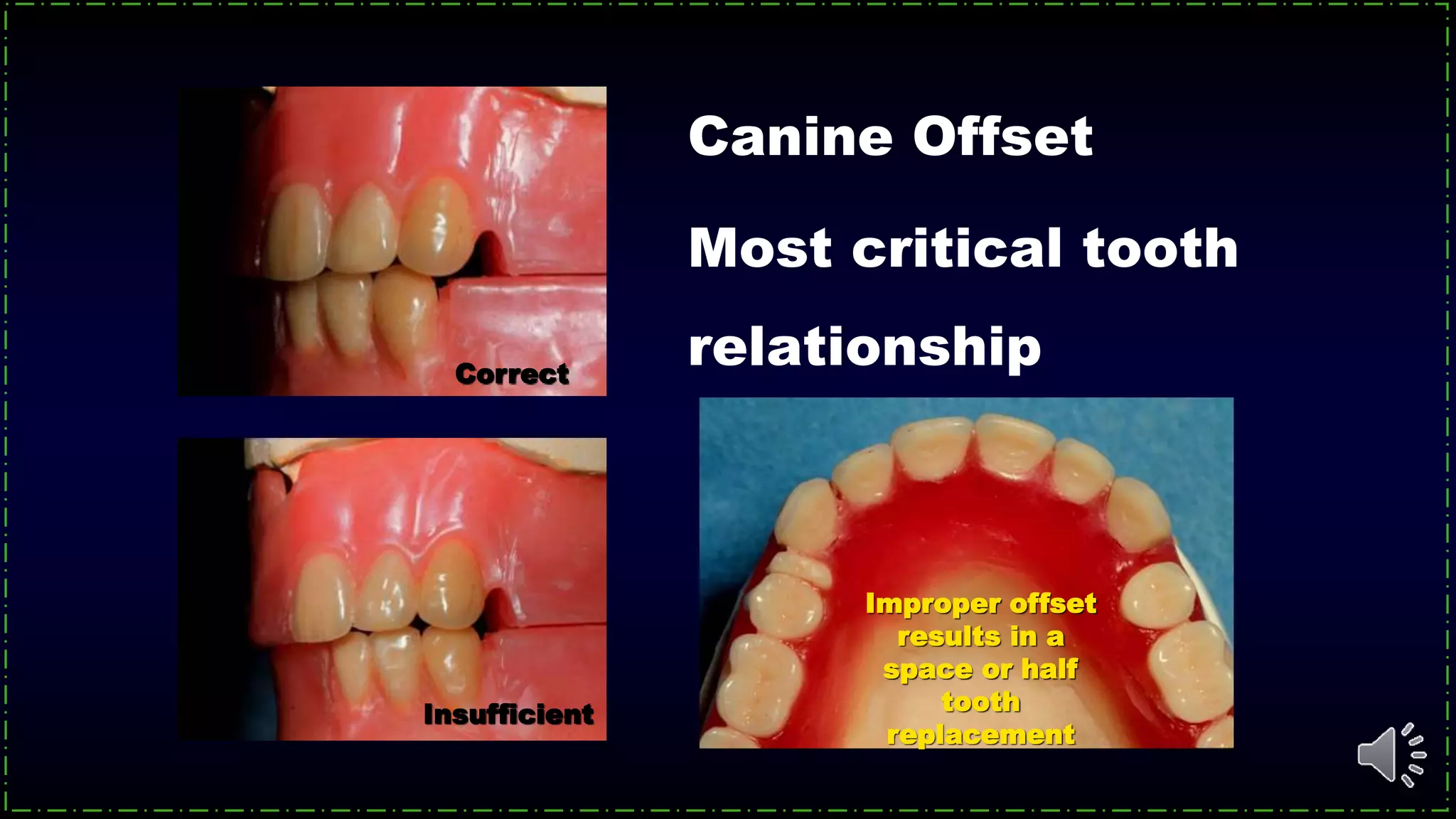 Canine Offset
Correct
Insufficient
Improper offset
results in a
space or half
tooth
replacement
Most critical tooth
relationship
 