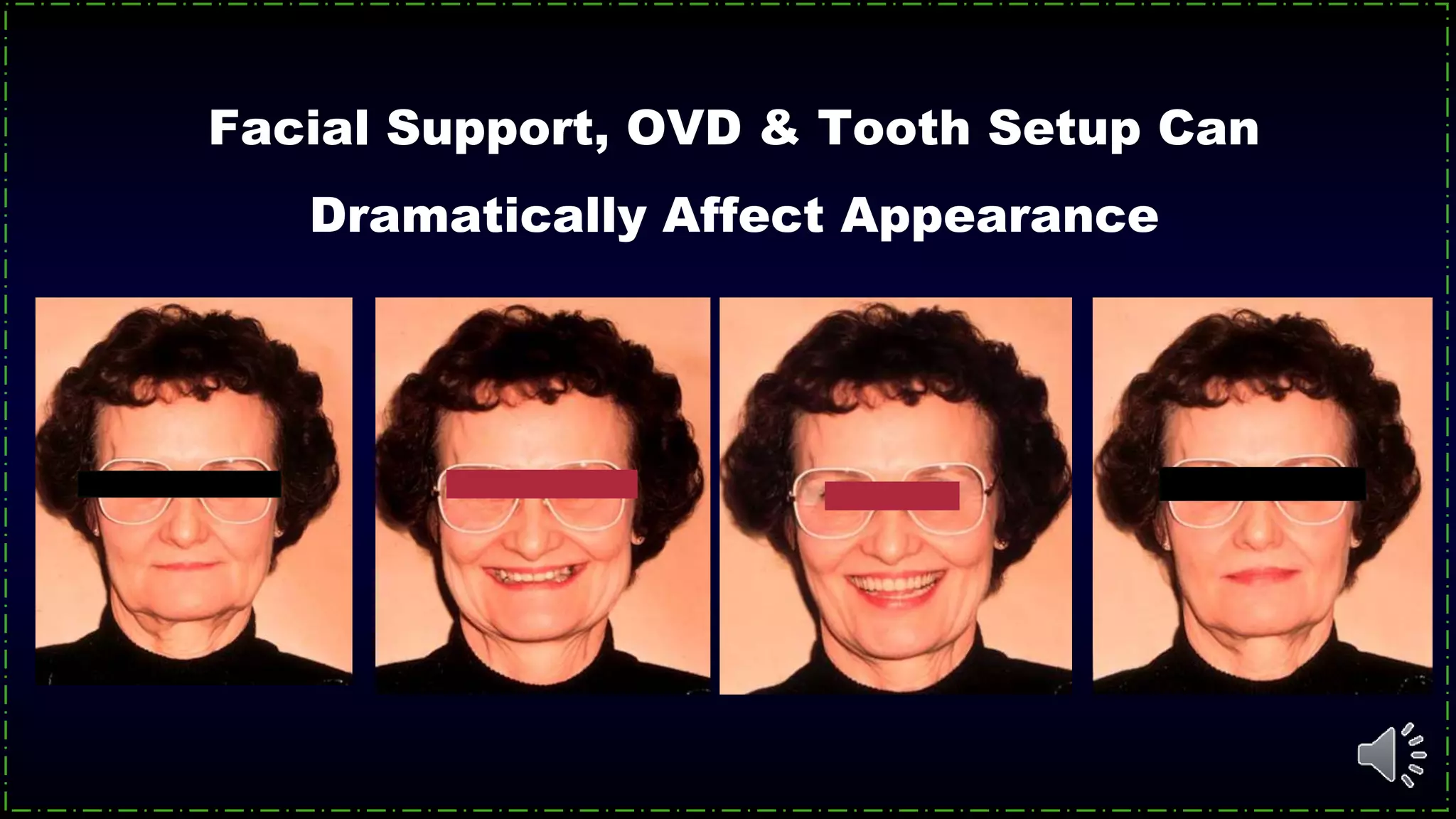 Facial Support, OVD & Tooth Setup Can
Dramatically Affect Appearance
 