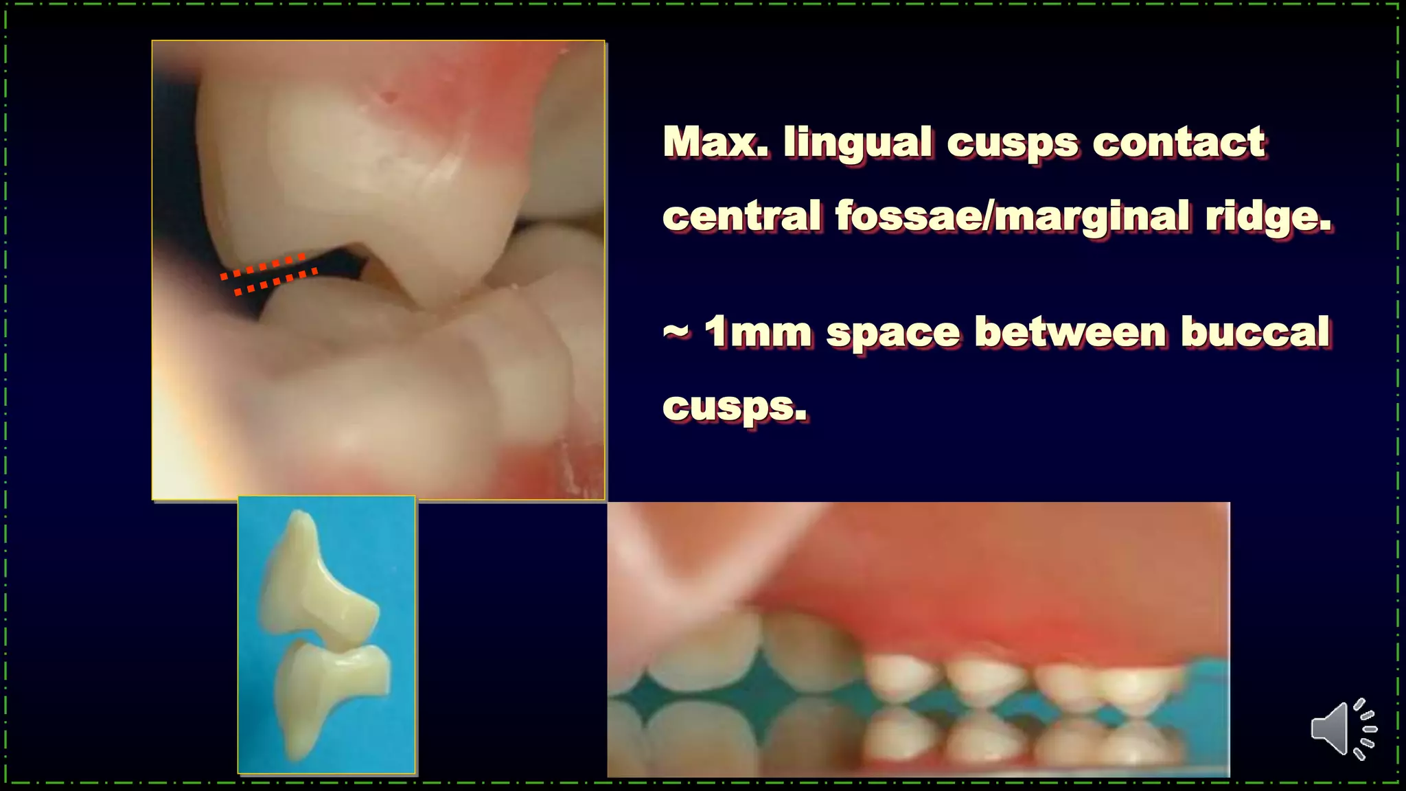 Max. lingual cusps contact
central fossae/marginal ridge.
~ 1mm space between buccal
cusps.
 