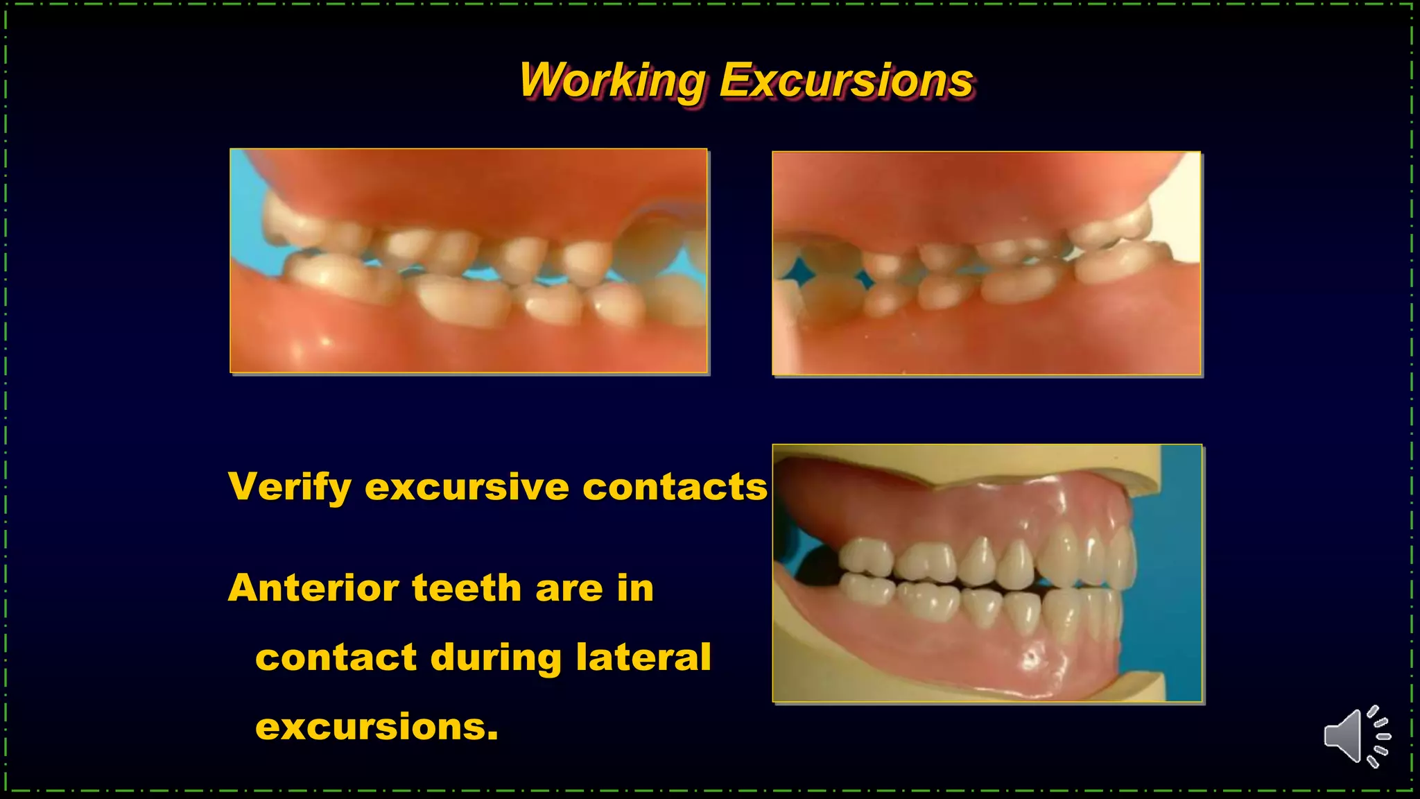 Verify excursive contacts
Anterior teeth are in
contact during lateral
excursions.
Working Excursions
 