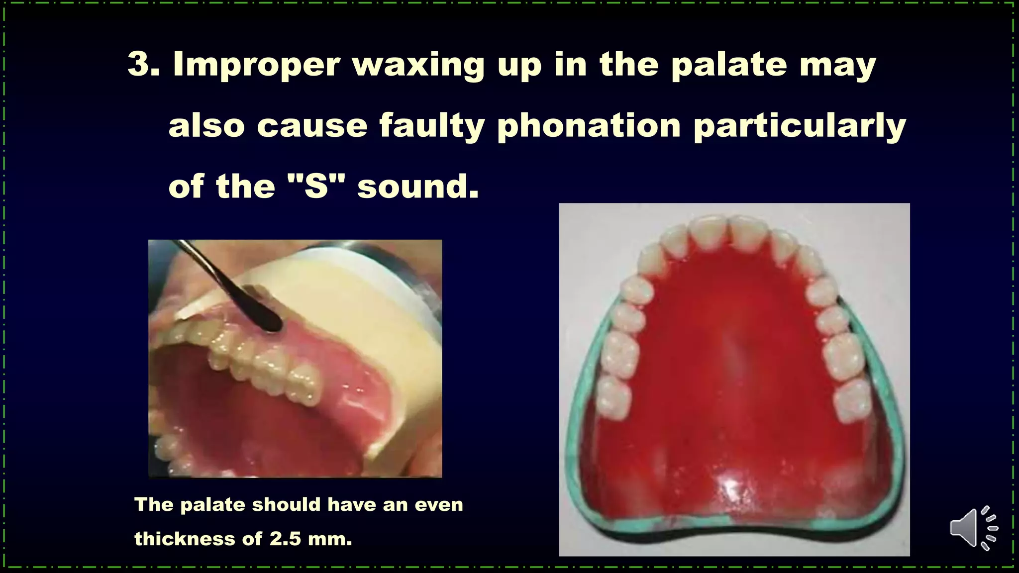 3. Improper waxing up in the palate may
also cause faulty phonation particularly
of the "S" sound.
The palate should have an even
thickness of 2.5 mm.
 