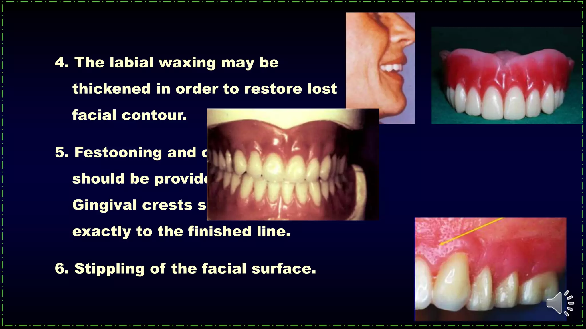 4. The labial waxing may be
thickened in order to restore lost
facial contour.
5. Festooning and cuspid eminence
should be provided.
Gingival crests should be trimmed
exactly to the finished line.
6. Stippling of the facial surface.
 