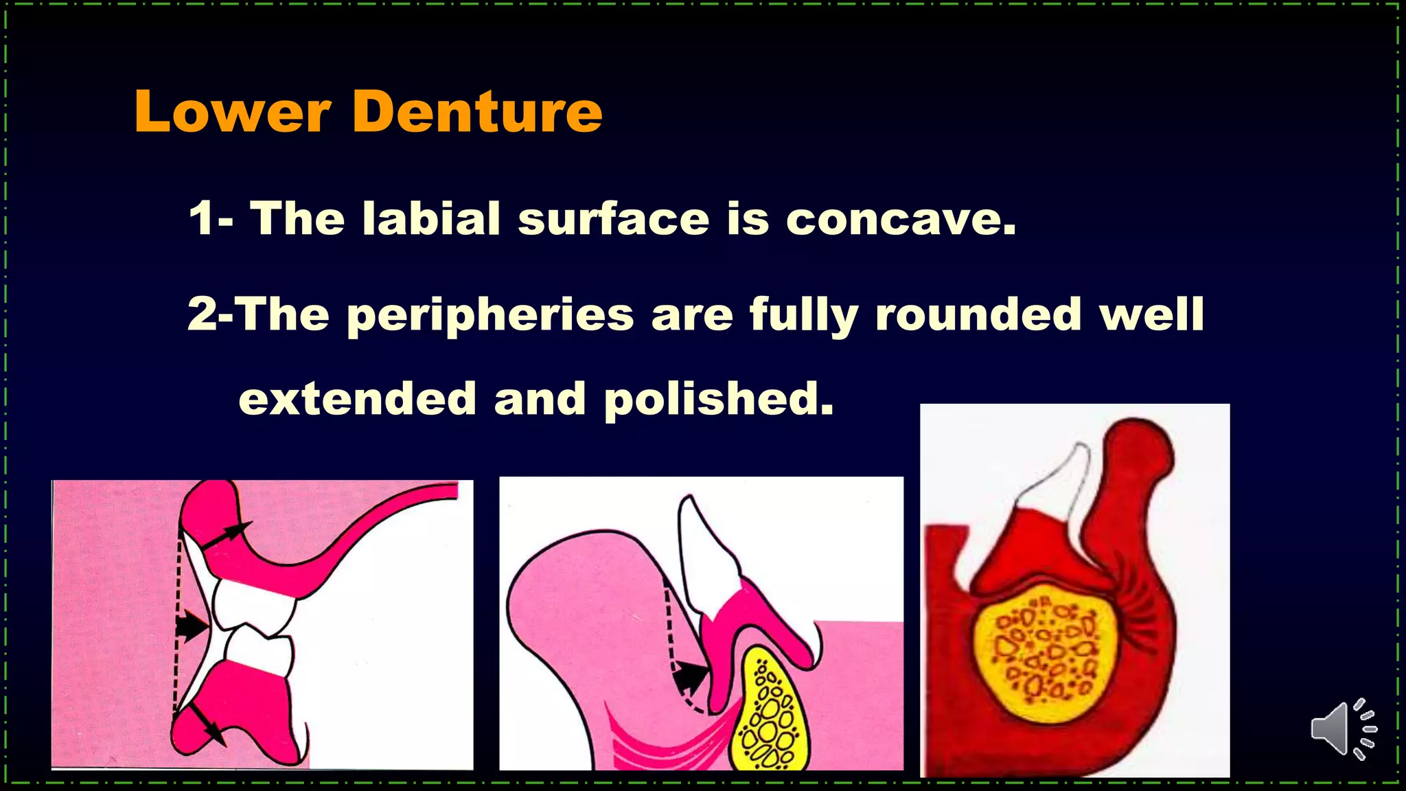 Lower Denture
1- The labial surface is concave.
2-The peripheries are fully rounded well
extended and polished.
 