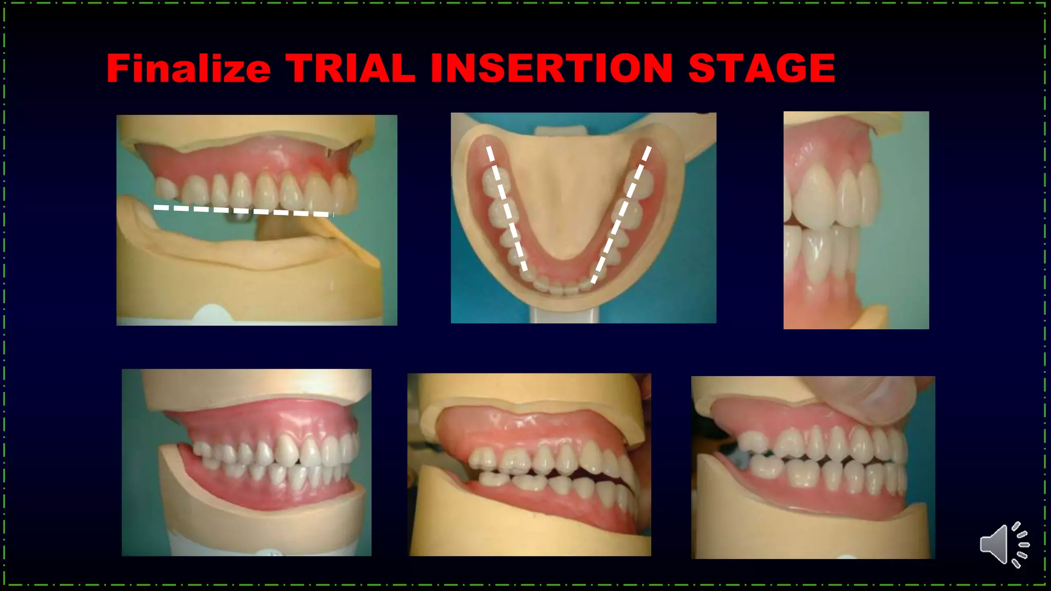 Finalize TRIAL INSERTION STAGE
 