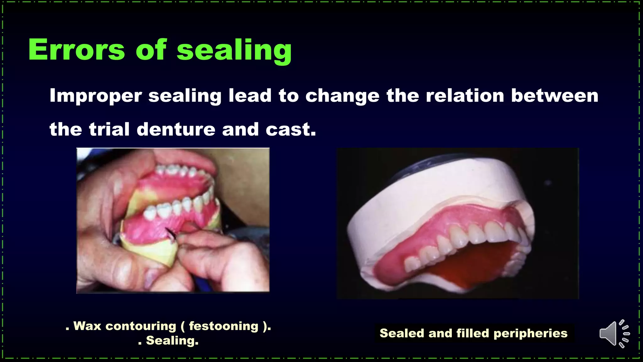 Sealed and filled peripheries
. Wax contouring ( festooning ).
. Sealing.
Improper sealing lead to change the relation between
the trial denture and cast.
Errors of sealing
 
