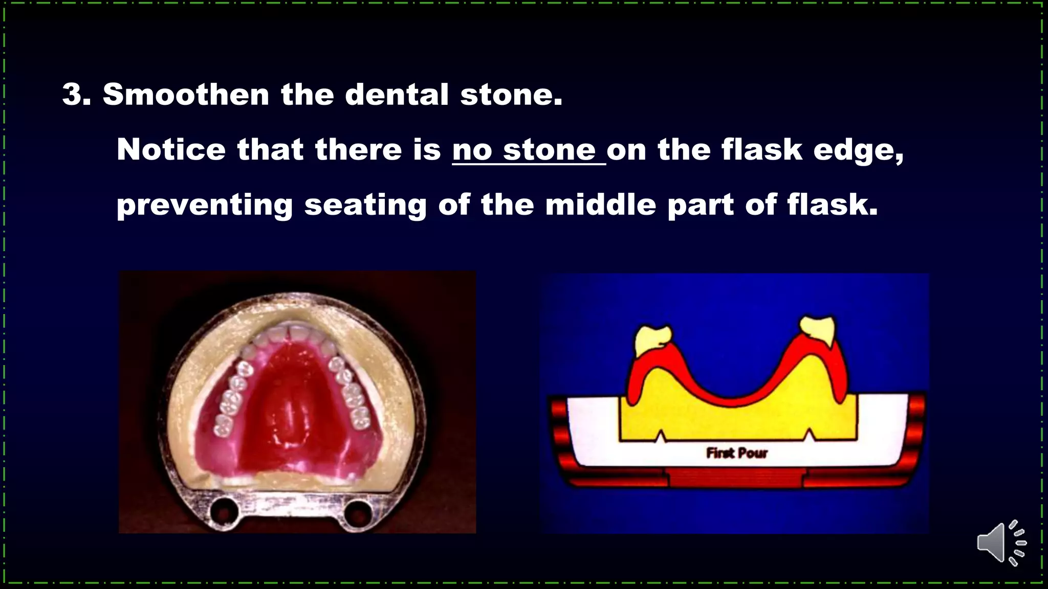 3. Smoothen the dental stone.
Notice that there is no stone on the flask edge,
preventing seating of the middle part of flask.
 