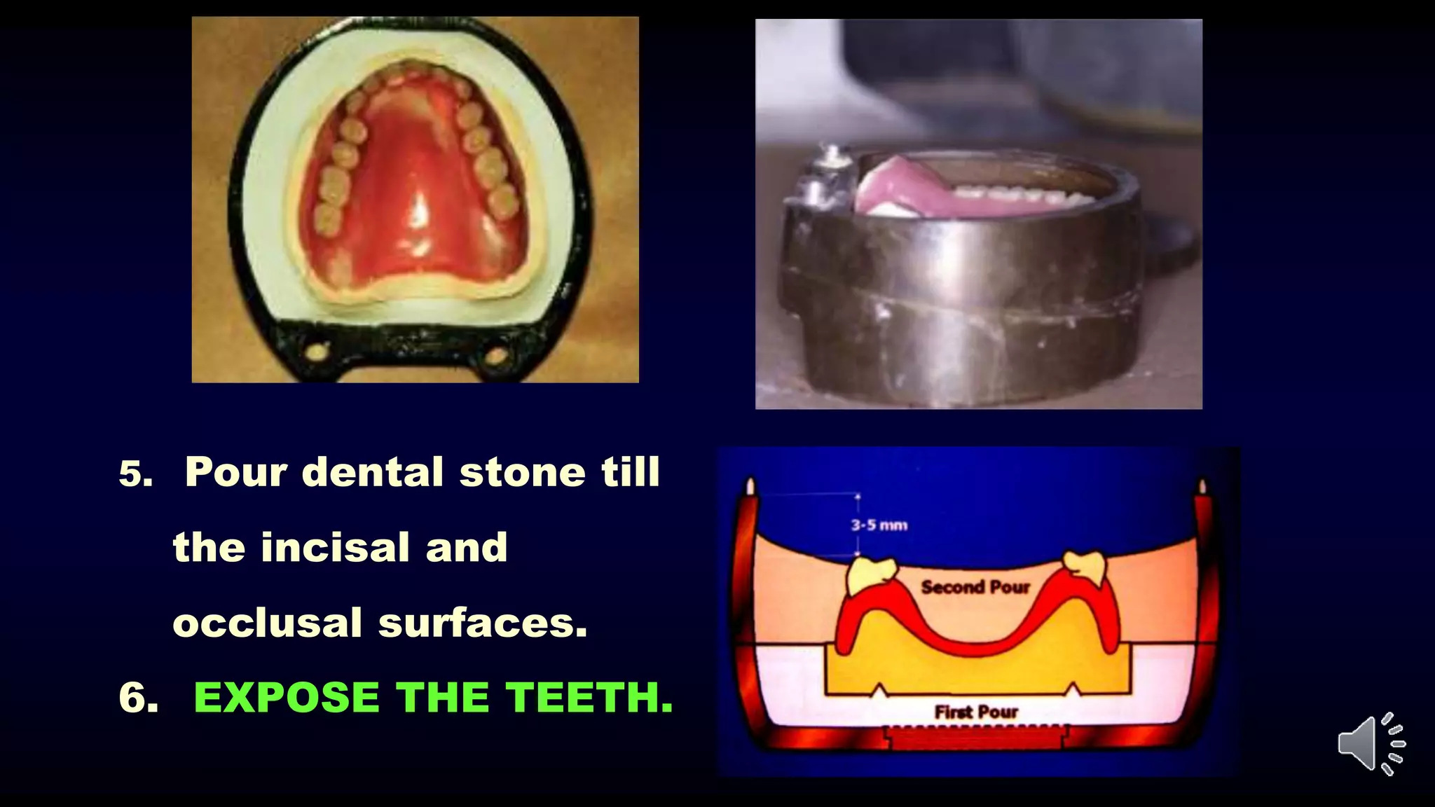 5. Pour dental stone till
the incisal and
occlusal surfaces.
6. EXPOSE THE TEETH.
 