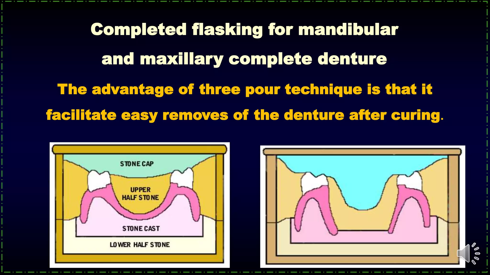 The advantage of three pour technique is that it
facilitate easy removes of the denture after curing.
Completed flasking for mandibular
and maxillary complete denture
 