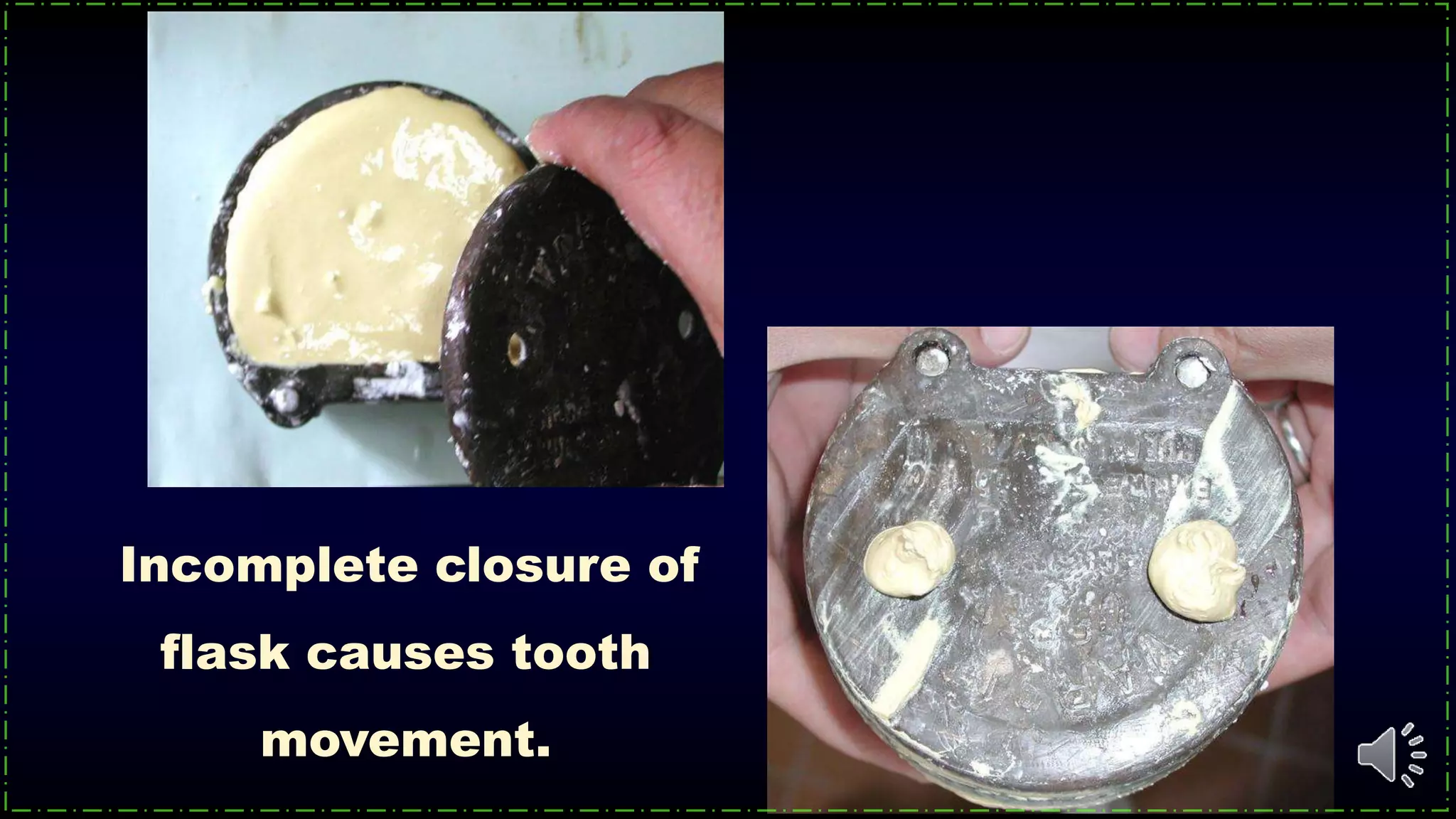 Incomplete closure of
flask causes tooth
movement.
 