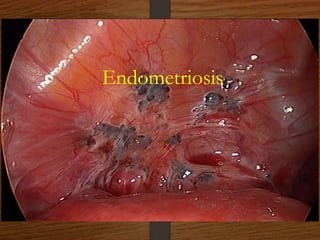Endometriosis
 