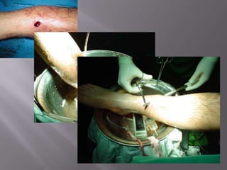 Evaluar lesión neurológica y vascular: importante examen fisicoFractura de piernaSegún la anatomía del rasgo: RxTransversales OblícuasEspiroídeasConminutas 