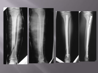 Fractura de PiernaEstudio:Rx pierna AP, lateral.