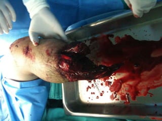 Incluir ambas articulaciones.Tratamiento inicial:Alineamiento