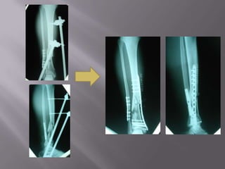 analgesiaTratamiento definitivo:Ortopédico.