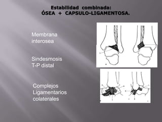 Fractura en hueso patológico.