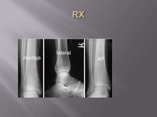Obesidad(relativa)Fractura de PiernaMétodo de fijación:Tutor externo.