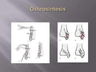 Clavo endomedular: (goldstandar)