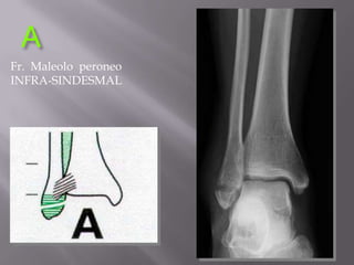 Fractura de pilontibial(plafondtibial)Fractura que involucra superficie articular de la tibia distalMecanismo por compresion axial: caidas de altura, accidentes de transitoLesioncartilago > frecuente que en fracturas de tobillo y consiguiente peor pronosticoLesion de partes blandas importante
