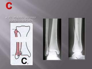 Fractura de pilontibial(plafondtibial)Estudio imagenologico con rx tobillo y piernaTAC es importante para determinar ttoTratamiento es quirurgicoReconstruccionanatomica + injerto oseo + placa  o TE