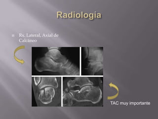 ClasificaciónBrunner y Weber (AO) 1982 segúnnivel de fractura de peronerespecto  a sindesmosisA : distal sindesmosisB  : al mismonivel de sindesmosisC  : proximal a sindesmosisMásaltamásdaño e inestabilidadClave Integridadligtibioperoneo posterior o susinserciones.
