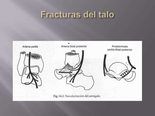 AFr.  Maleoloperoneo  INFRA-SINDESMAL