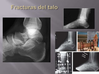 BFr.  MaleoloperoneoTRAN-SINDESMAL