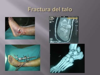 CFr.  MaleoloperoneoSUPRA-SINDESMAL.Fracturas del pie