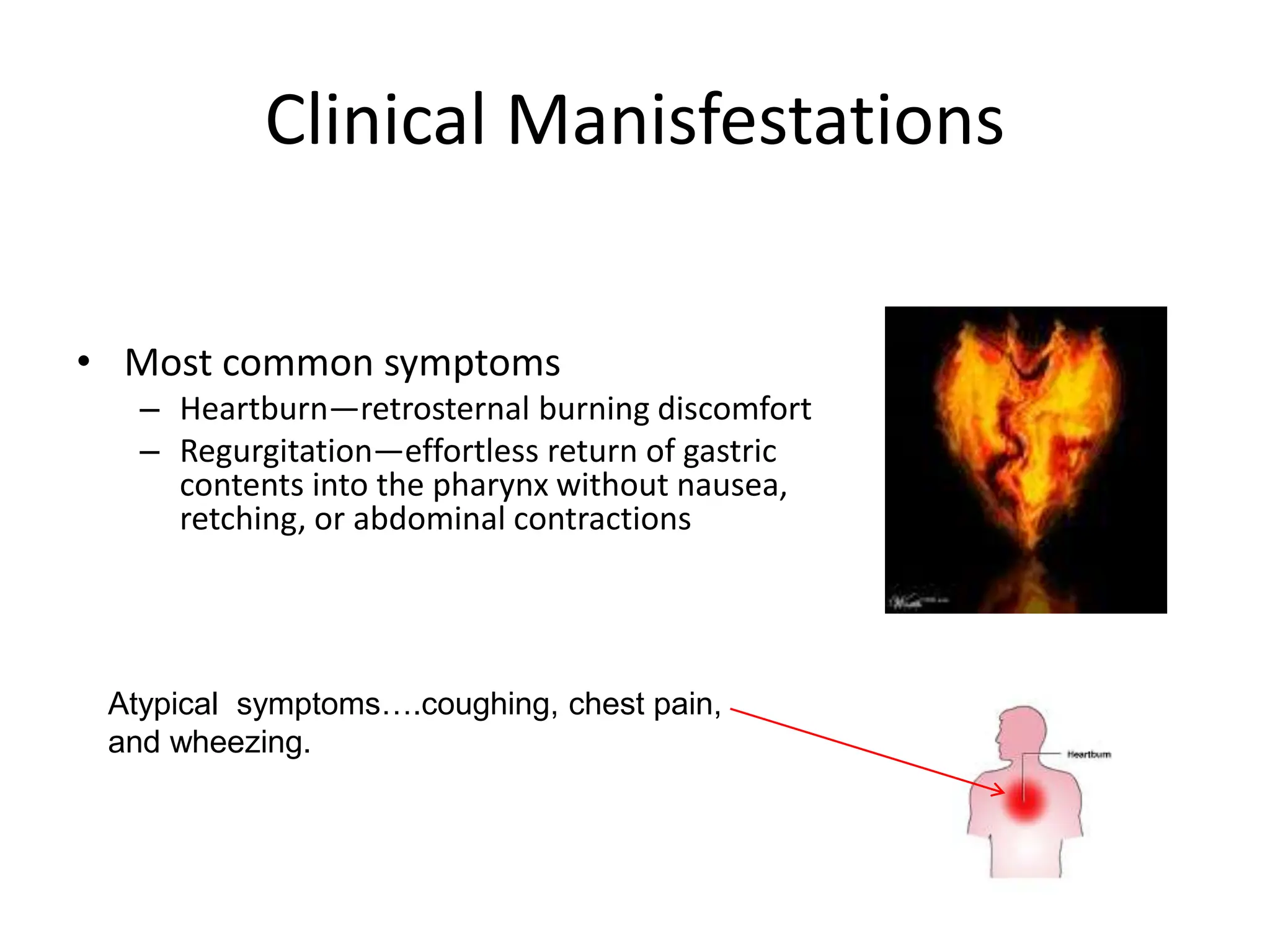 Clinical Manisfestations
• Most common symptoms
– Heartburn—retrosternal burning discomfort
– Regurgitation—effortless return of gastric
contents into the pharynx without nausea,
retching, or abdominal contractions
Atypical symptoms….coughing, chest pain,
and wheezing.
 