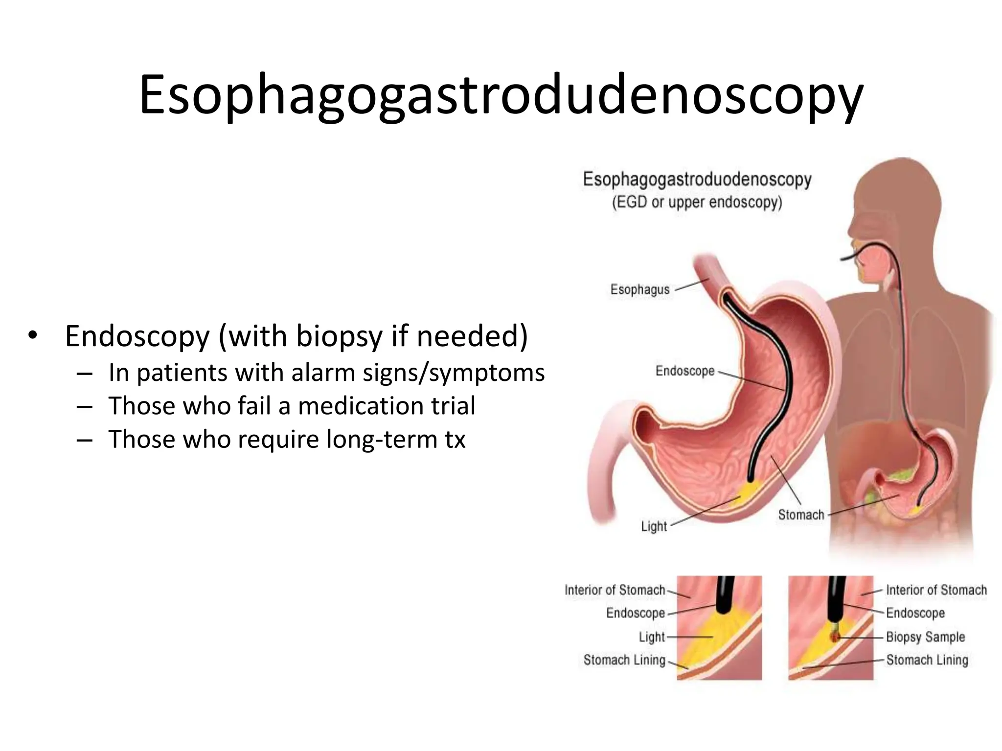 Esophagogastrodudenoscopy
• Endoscopy (with biopsy if needed)
– In patients with alarm signs/symptoms
– Those who fail a medication trial
– Those who require long-term tx
 
