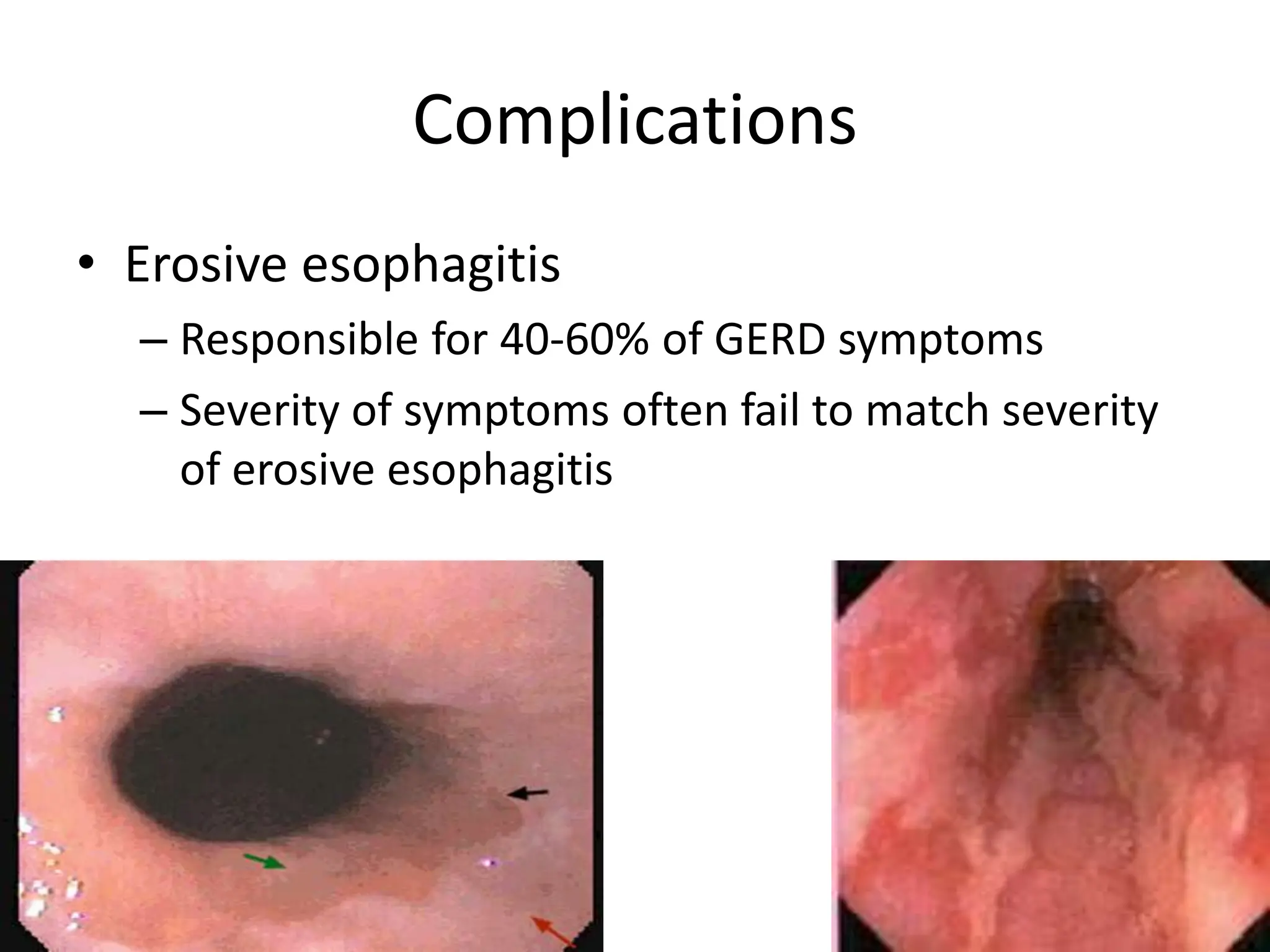 Complications
• Erosive esophagitis
– Responsible for 40-60% of GERD symptoms
– Severity of symptoms often fail to match severity
of erosive esophagitis
 