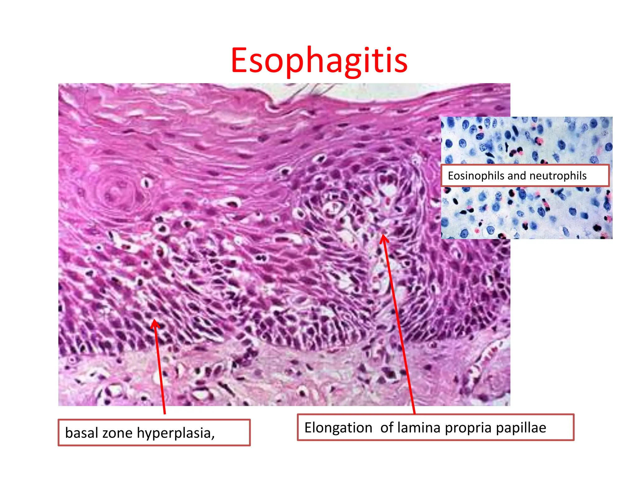Esophagitis
basal zone hyperplasia, Elongation of lamina propria papillae
Eosinophils and neutrophils
 